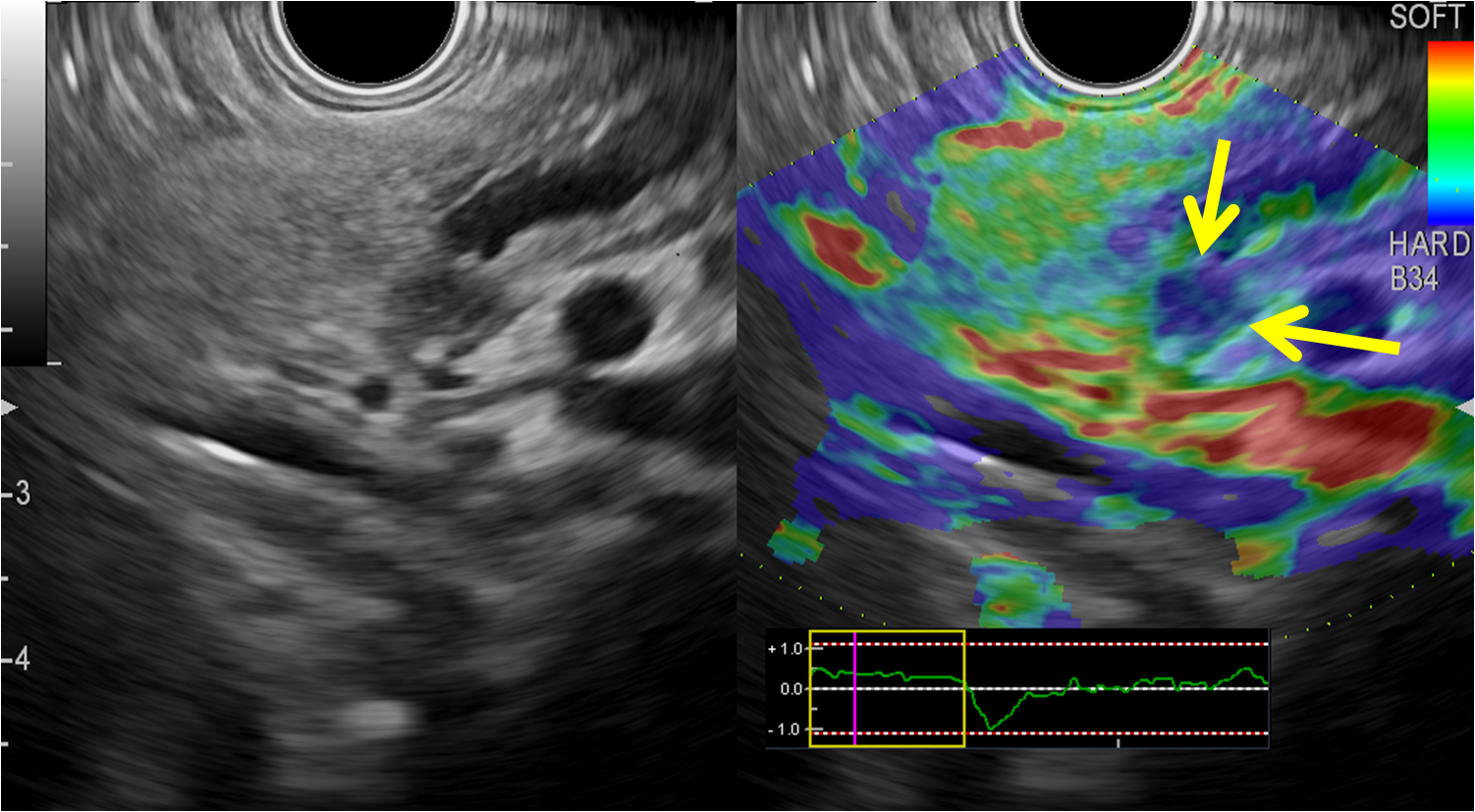 Эус желудка. Эластография лимфатических узлов. Эндоскопическая ультрасонография поджелудочной железы. Эндосонография желудка. Эластография поджелудочной железы.