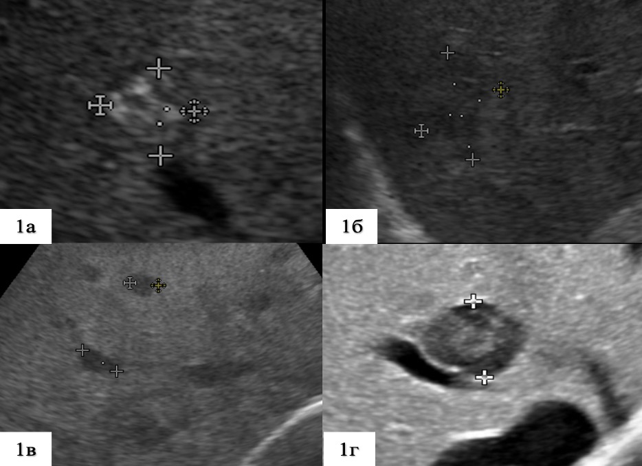 Колоректальные метастазы в печени. Как выглядят метастазы на УЗИ. Эффект дорсального усиления на УЗИ. Эффект акустического усиления на УЗИ.